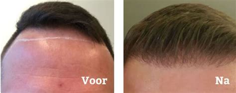 De Impact Van Lifestyle Op Haartransplantatie Resultaten