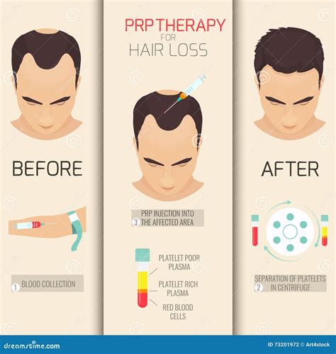 De Wetenschap Achter PRP Therapie Voor Haarverlies