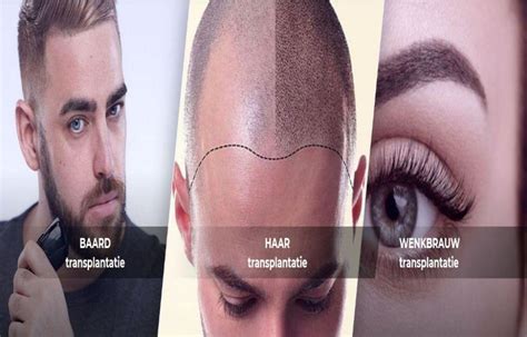 Haartransplantatie En Mentale Gezondheid