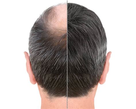 De Meest Gevraagde Vragen Over Haartransplantatie