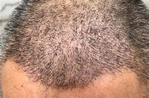De Psychologische Vooruitgang Na Een Haartransplantatie