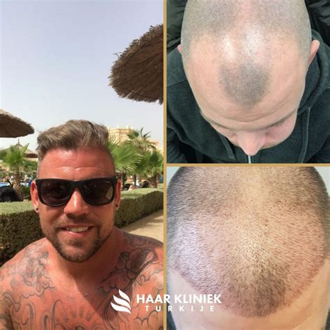 Een Haartransplantatie Vergelijking: Nederland Vs Turkije