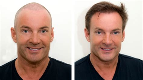Zorg Voor Je Nieuwe Haar Na Een Transplantatie