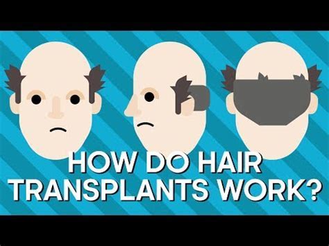 De Geschiedenis Van Haartransplantatie: Van Toen Tot Nu