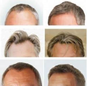 Wetenschap Achter Haartransplantatie: Hoe Werkt Het?